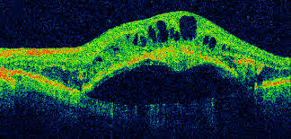 Role Of Advanced Retinal Imaging In Management Of Neovascular AMD