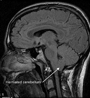 HerniatedCerebellum