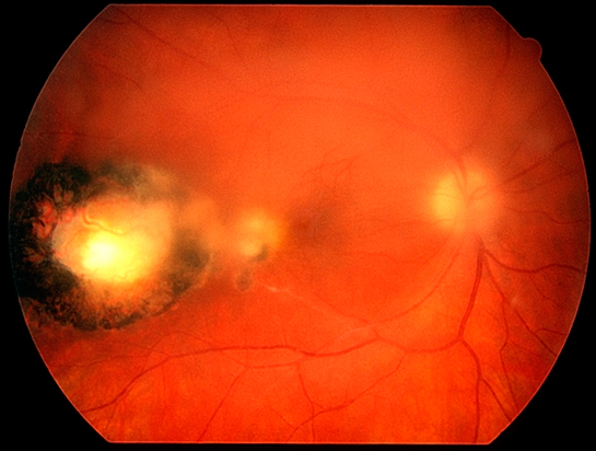 Uveitis Case Study