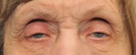 Elderly Diplopia