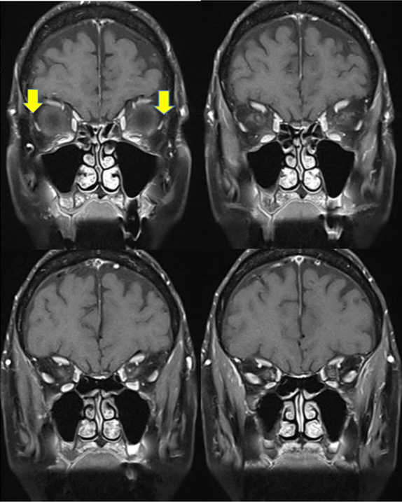 MRI - Sagging Eye