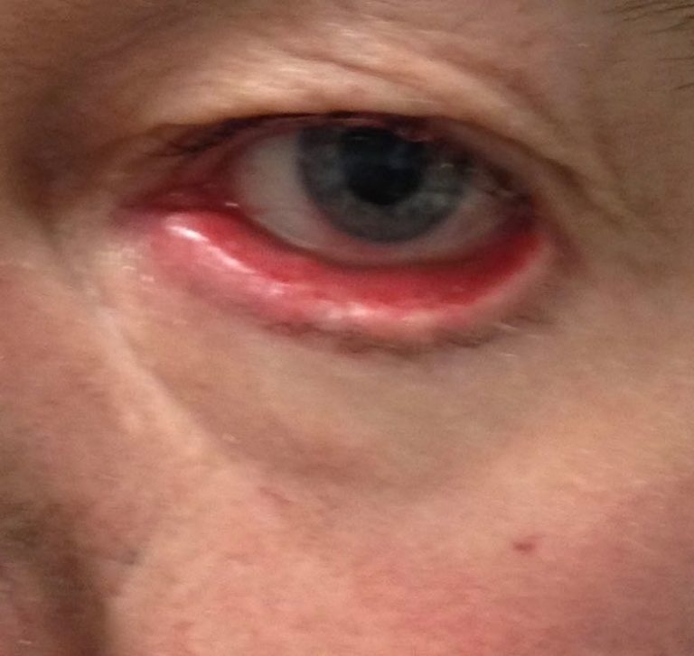 List 99+ Pictures Why Is There A Hole In My Bottom Eyelid Superb