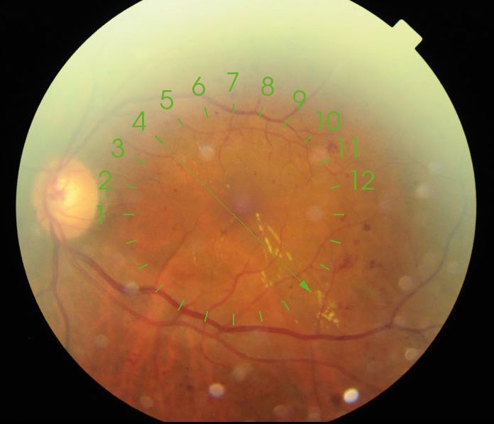 DiabteicRetinopathyAugust2017 1