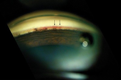 NeovascularGlaucoma