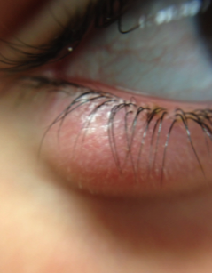 A Common Eyelid Lesion You All Manage