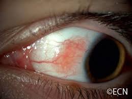 An Enlarging Conjunctival Lesion On A Teenager