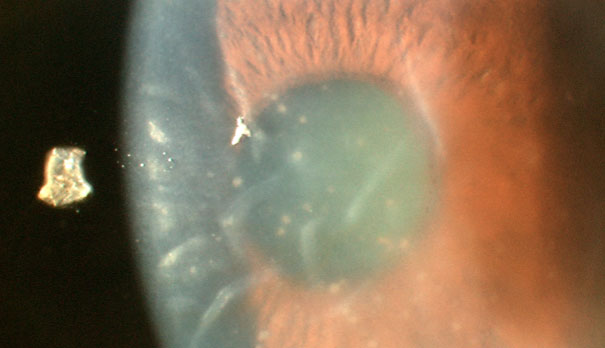 A Case Of Hypertensive Uveitis