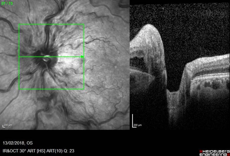 Rapid Resolution Of Unilateral  Haemorrhagic Retinopathy In A Young Patient