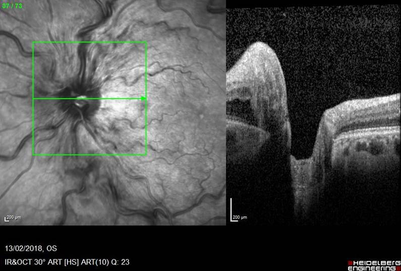 Unilateral Fundus Change 1