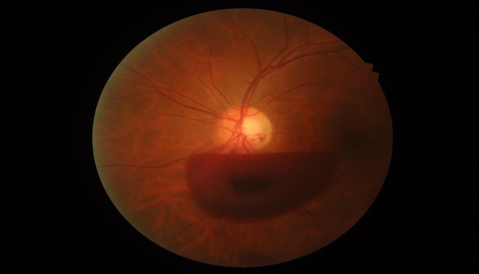 Valsalva Retinopathy