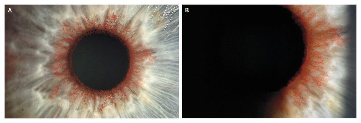 Neovascularisation