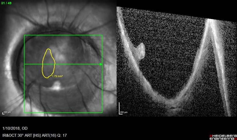 Optic Disc Coloboma