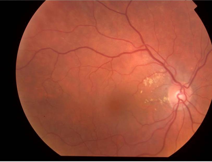 Right Peripapillary Choroidal Polyp 1