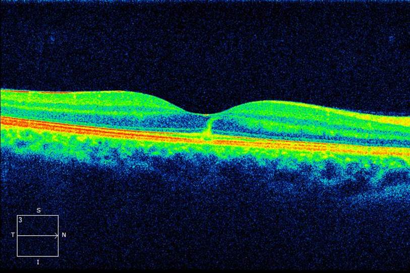 Bilateral Solar Maculopathy3