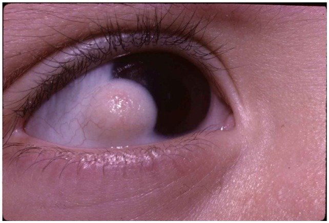 Grade 1 Limbal Dermoid.png