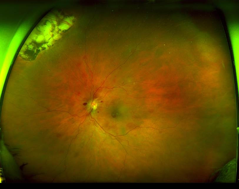 Quiz Challenge – 69yo Blurry Vision