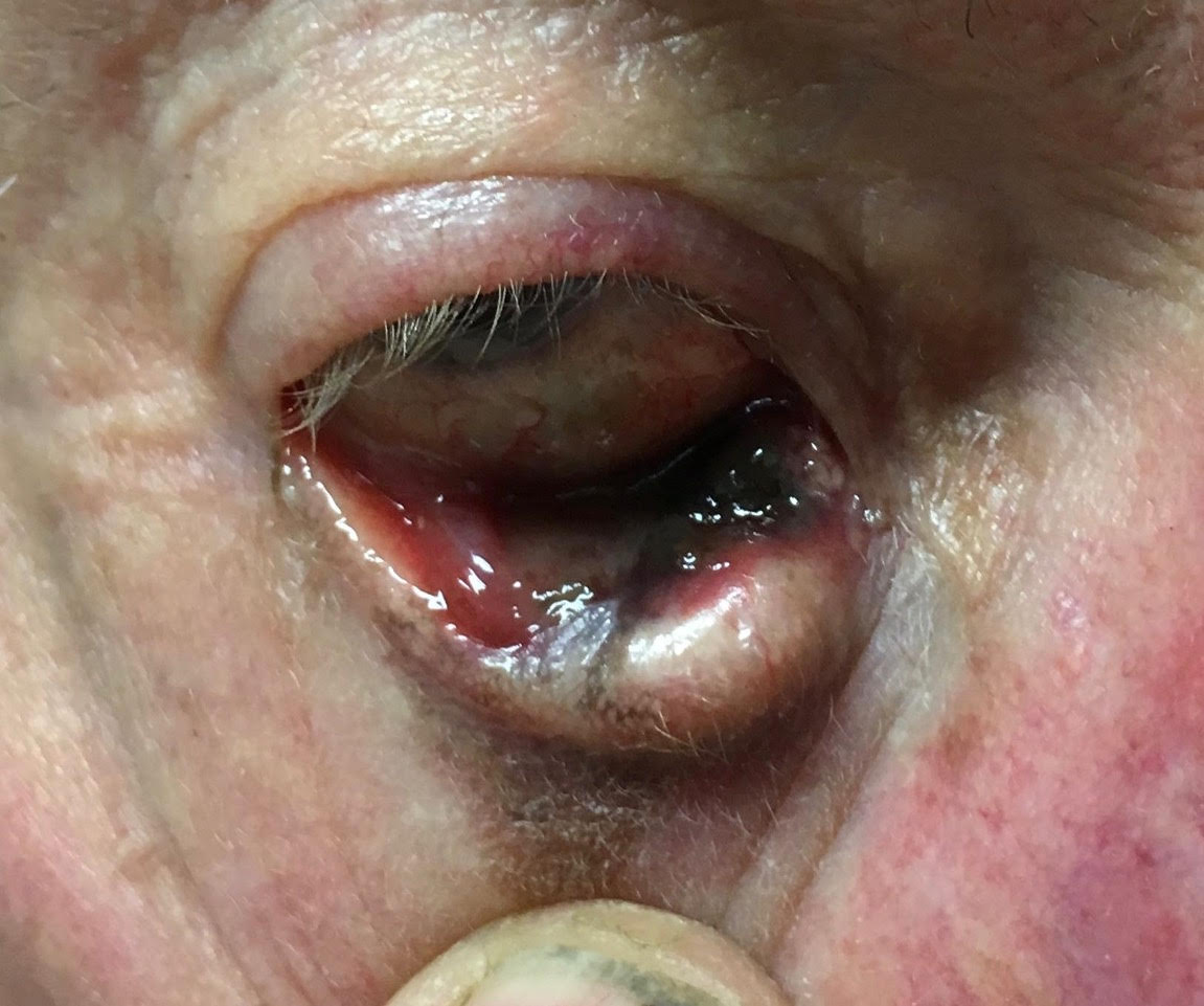 Quiz Challenge – 70yo With Lower Lid Lesion