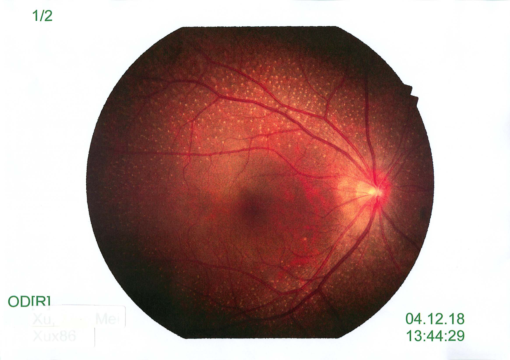 Quiz Challenge – 30yo With Reduced Vision And Night Vision Issues