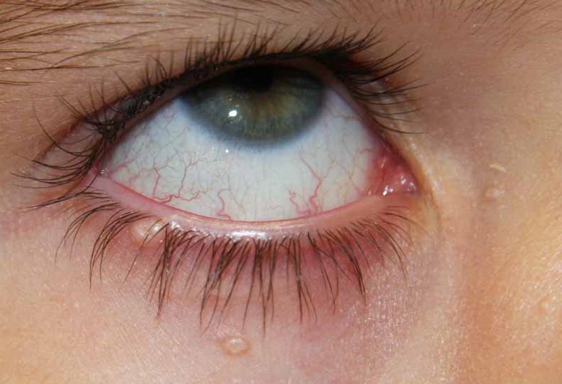 Quiz Challenge – Do You Know Why This Child Has Recurrent Red Eye?